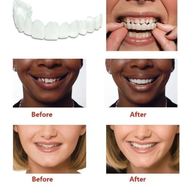 Magic Teeth Snap On Veneers – Bild 2