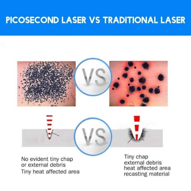 Pikosekunden-Laserstift zur Entfernung von Flecken und Sommersprossen – Bild 6